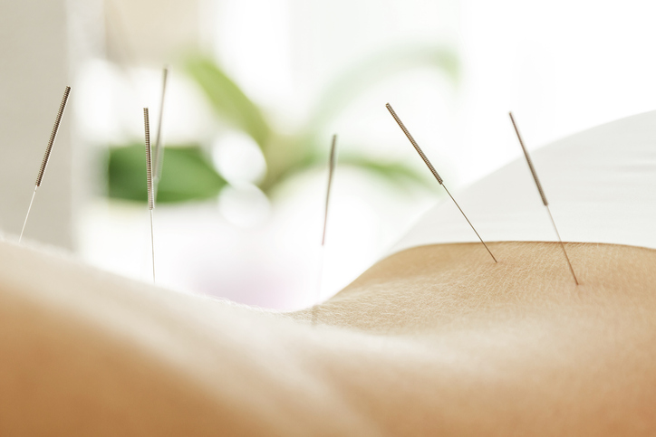 Close-up of female back with steel needles during procedure of acupuncture therapy