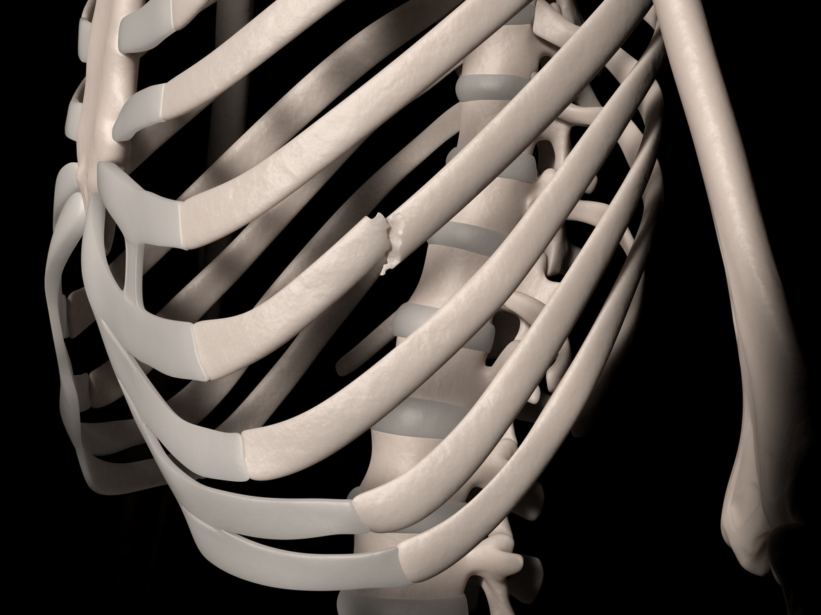 difference between bruised and cracked ribs