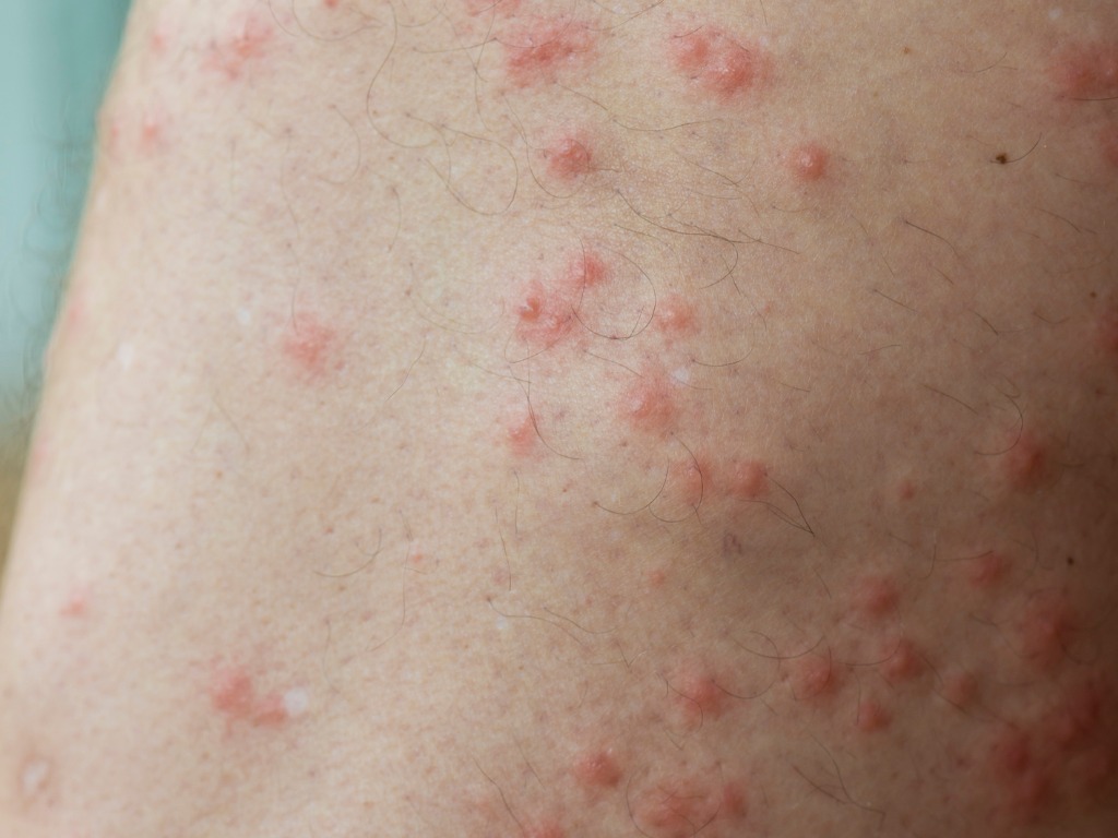 Strong allergic reaction from sandfly bite (UPDATE: Borrelia