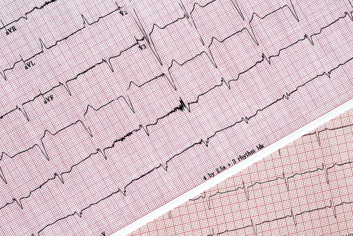 Heart monitor chart