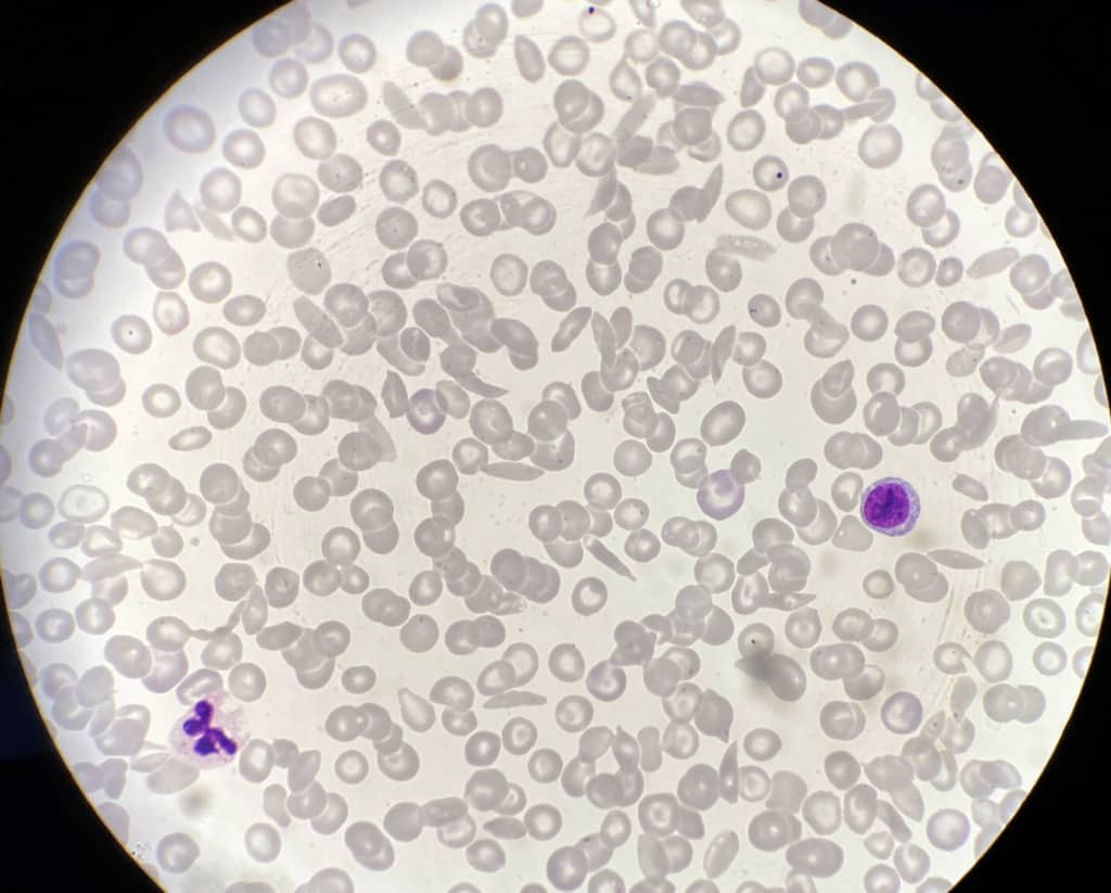 Blood smear of sickle cells and normal red and white blood cells stock (1)