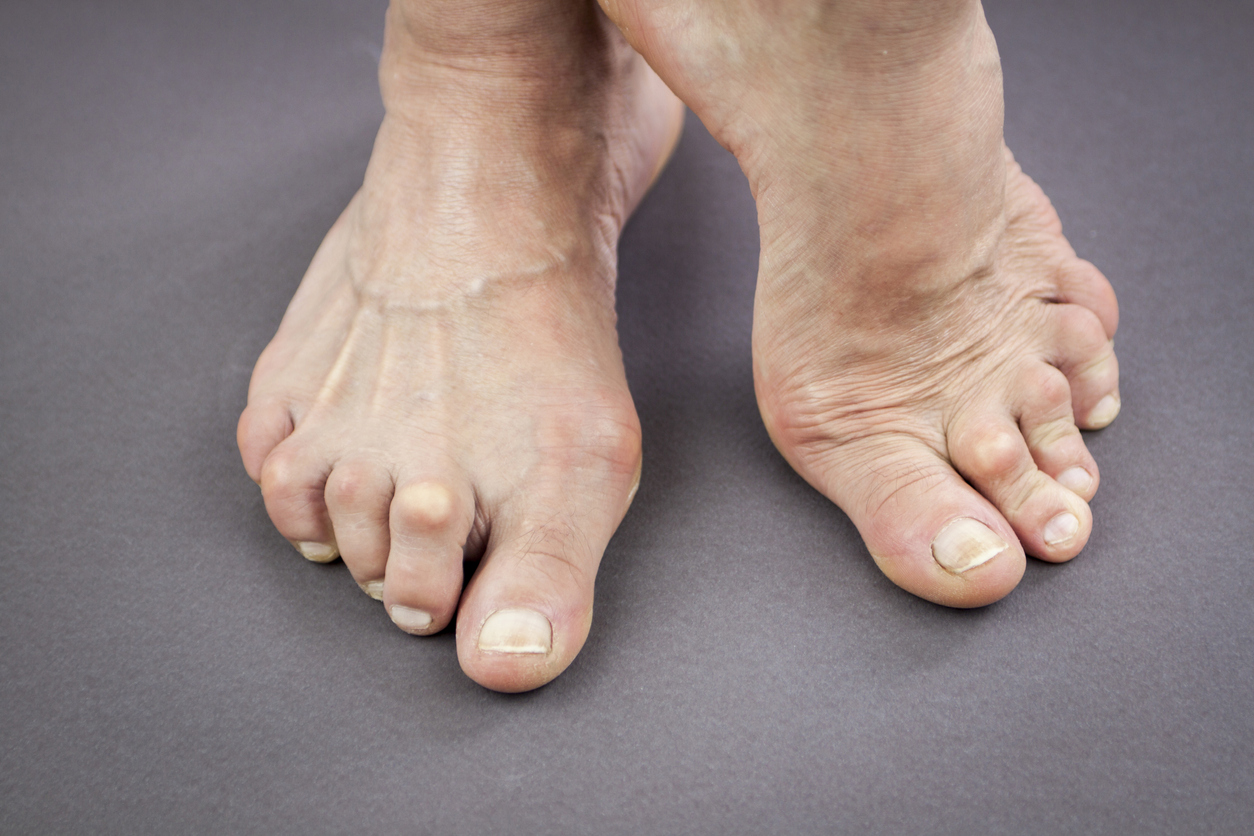 Feet Of Woman with Rheumatoid Arthritis