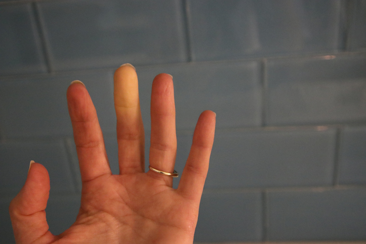 raynaud-s-syndrome-causes-symptoms-treatments-and-self-care-tips