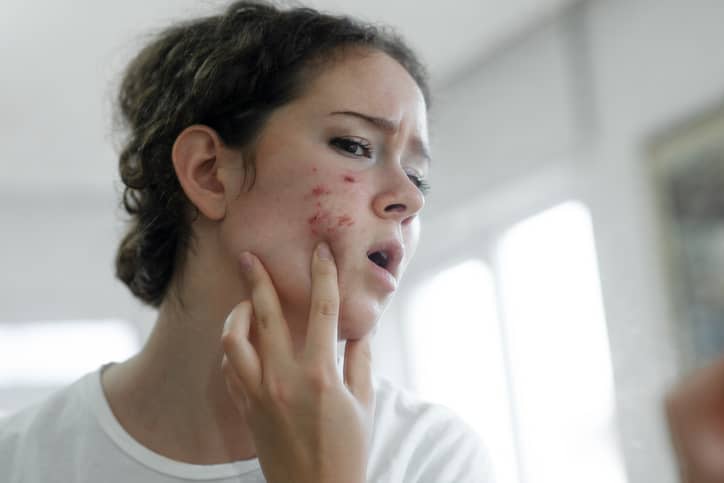 Woman with acne