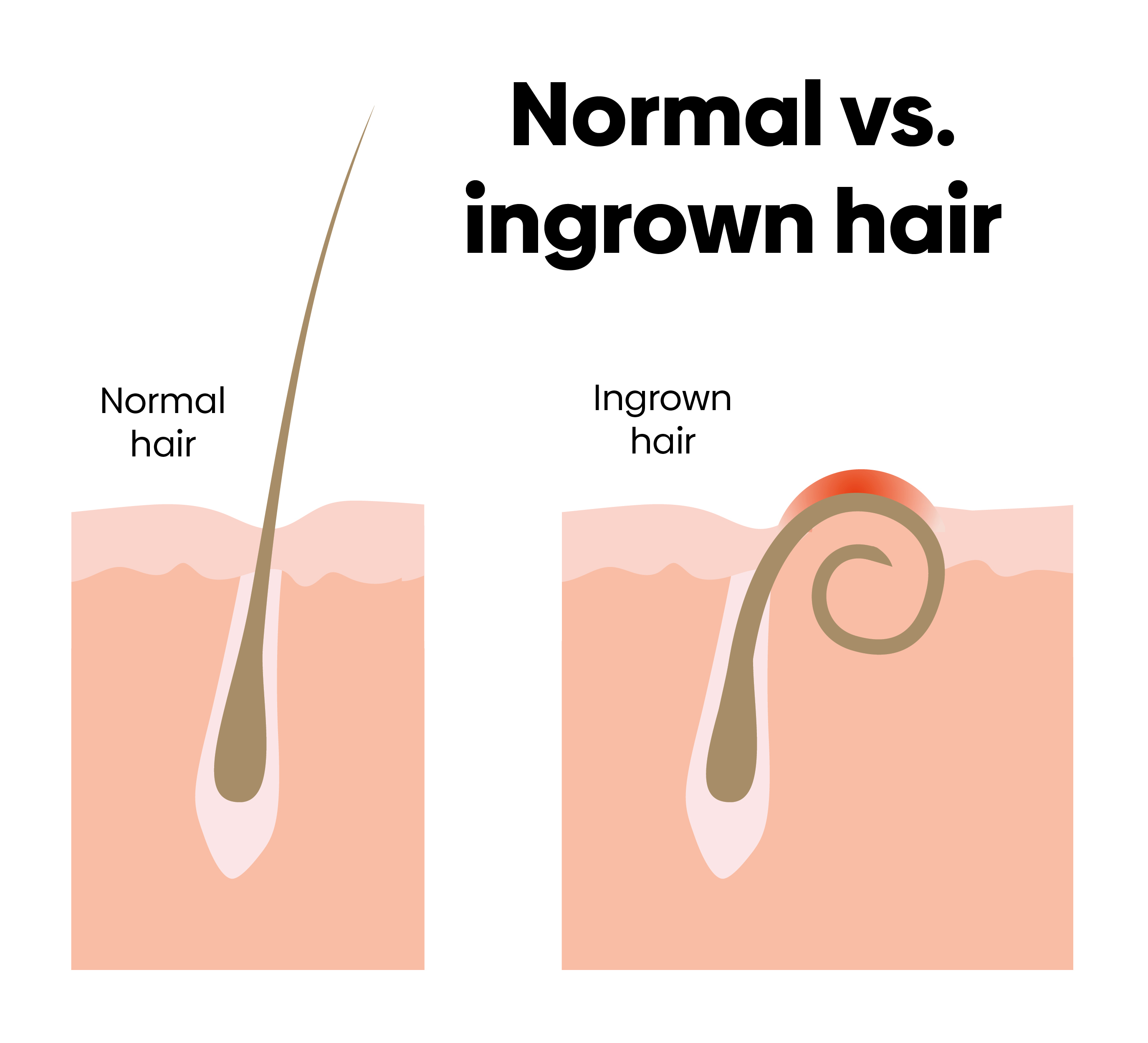  Ingrown hairs illustration 