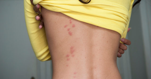 Bedbug bites on back look like itchy red rash
