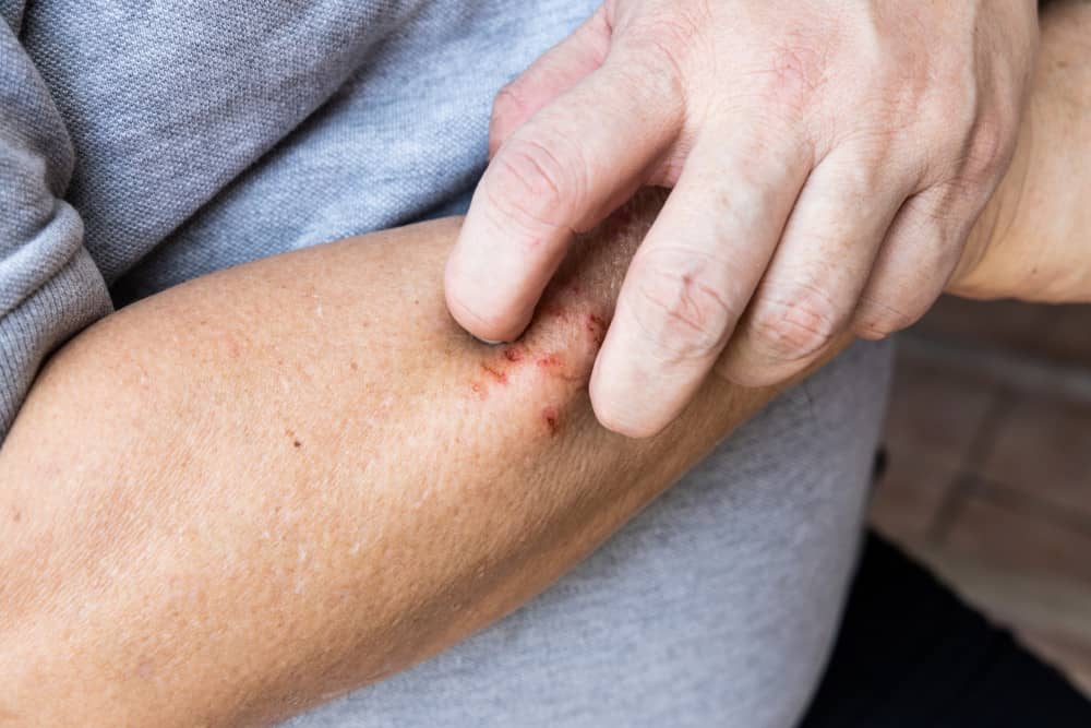 eczema scratching arm
