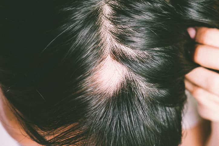 Scalp conditions that cause hair loss: symptoms, causes and treatment