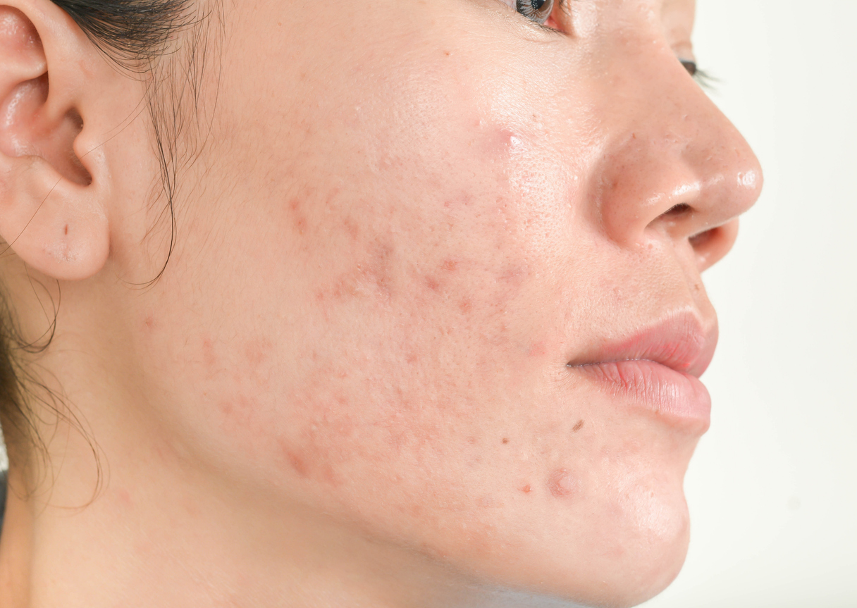 Close up of side of young adult woman's face with mild acne.