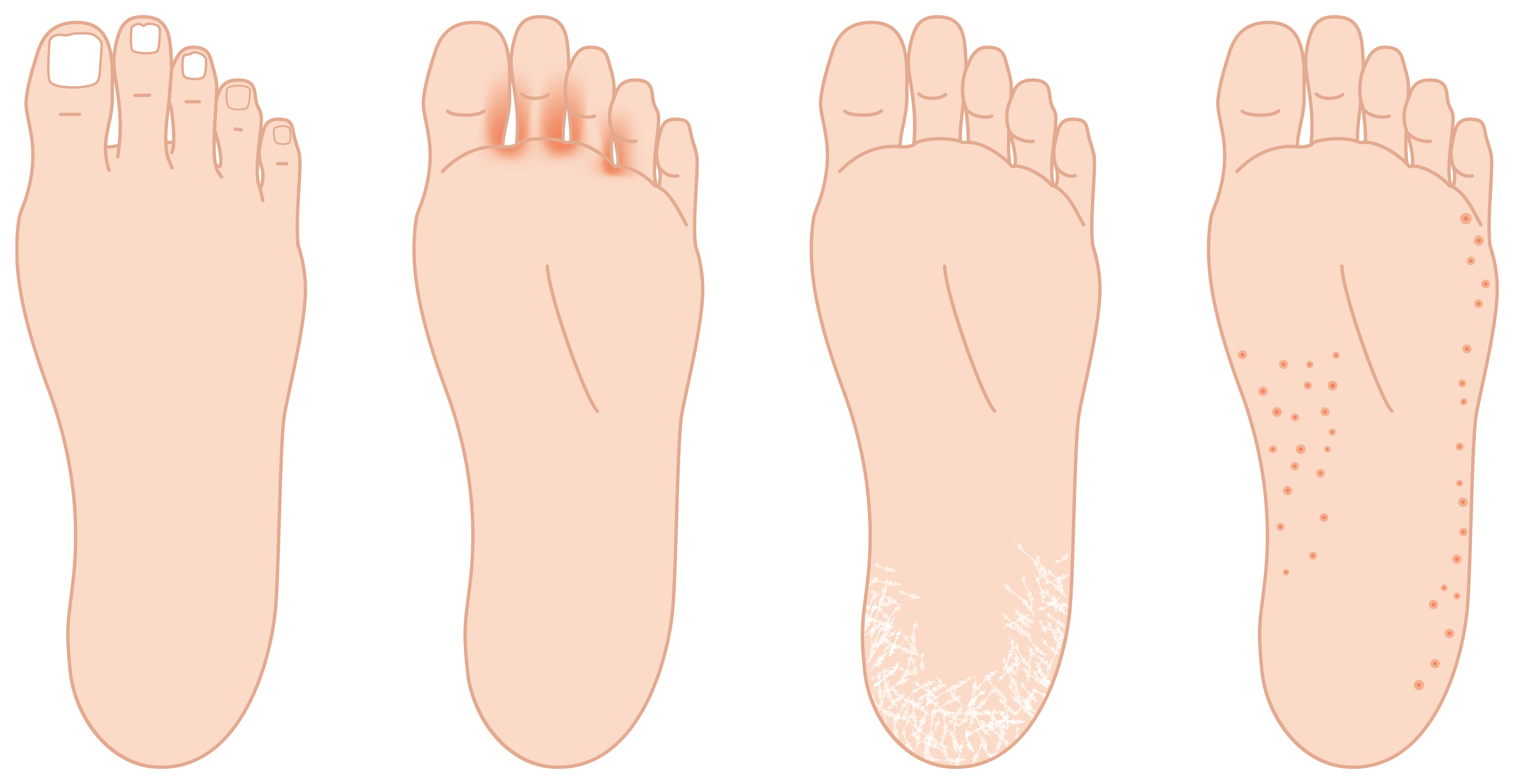 Foot infections: What causes them?