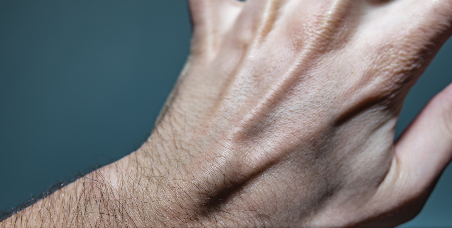 Lumps under skin - ganglion cyst lump on hand