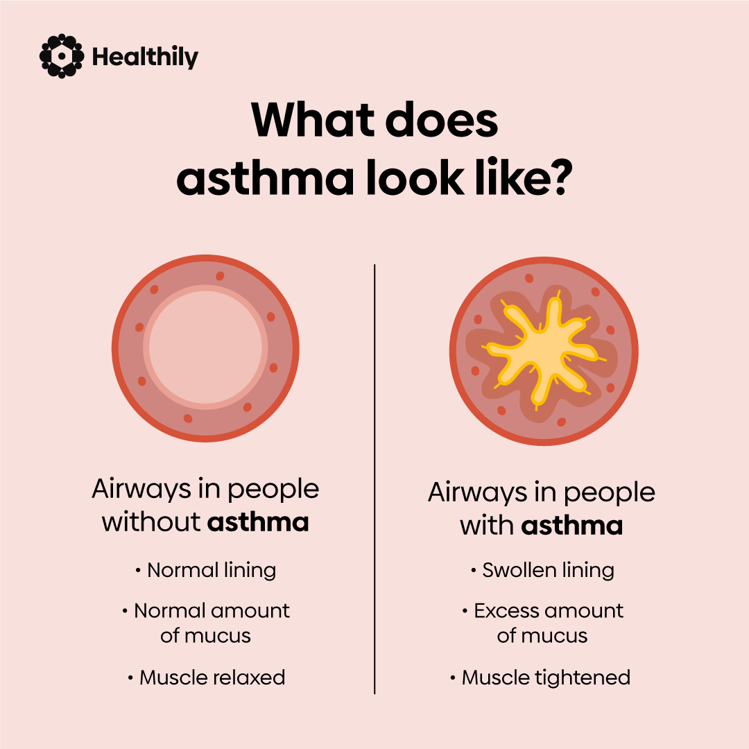 What does asthma look like?