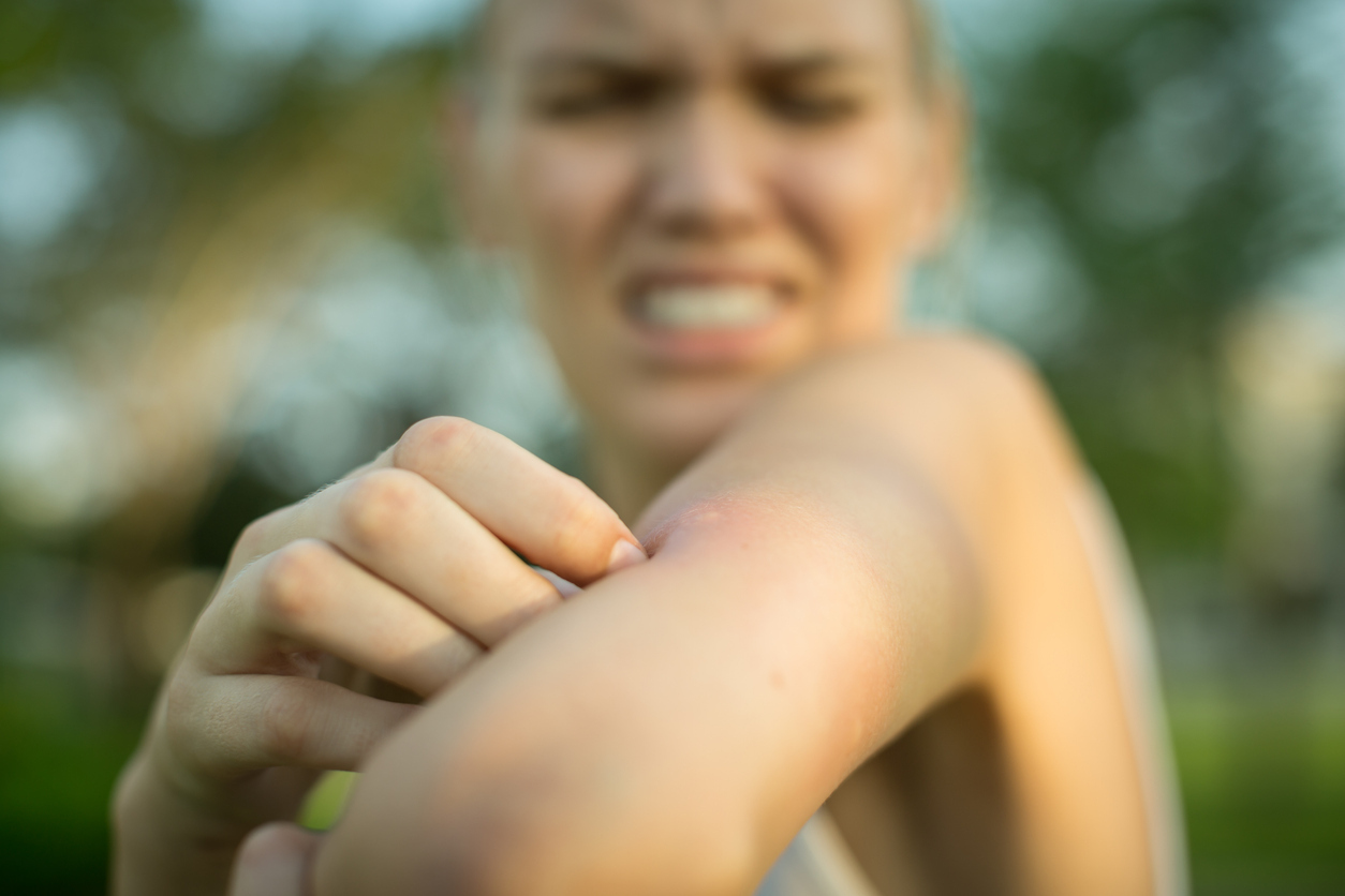 close-up of a person scratching a bite on the arm