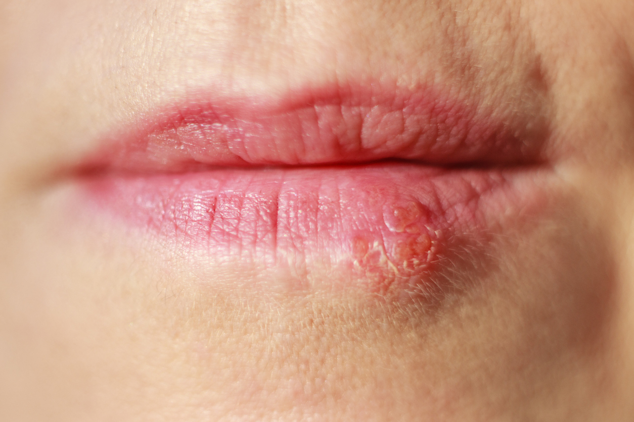 Cold sore by the lip of woman