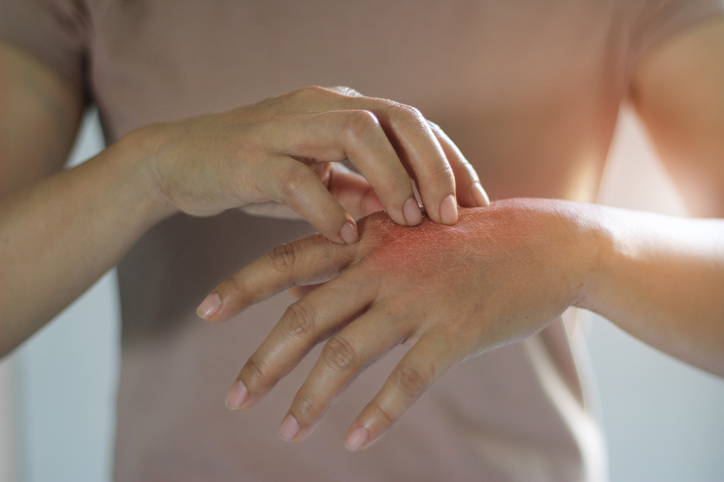 Woman scratching a red patch of skin on her hand
