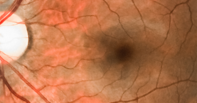 Central retinal vein occlusion is when the main vein that drains blood from your retina gets blocked