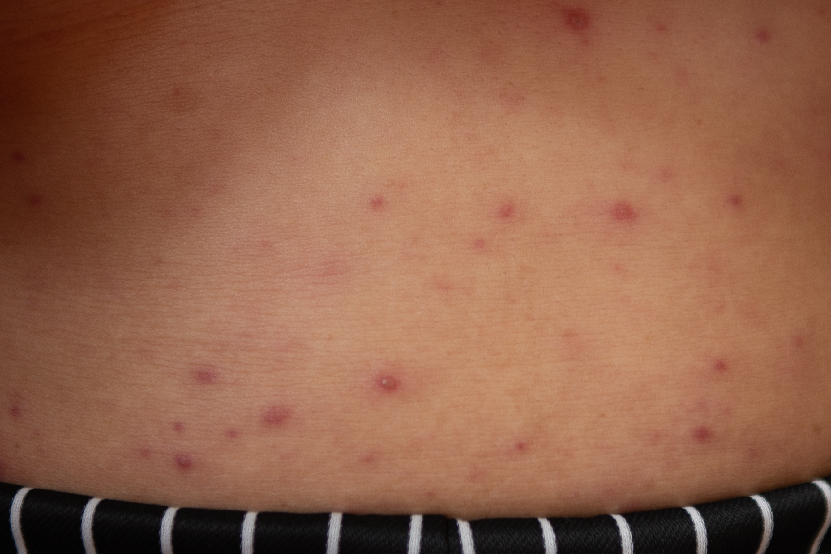 Pustules caused by viral infections or chickenpox disease 