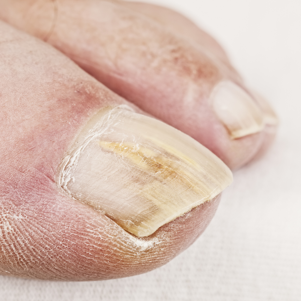 how-can-i-prevent-a-fungal-toenail-infection