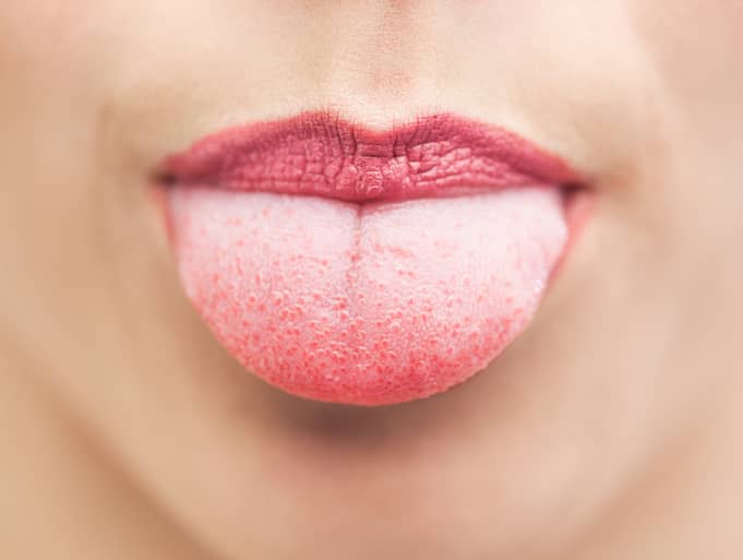 gonorrhea on tongue