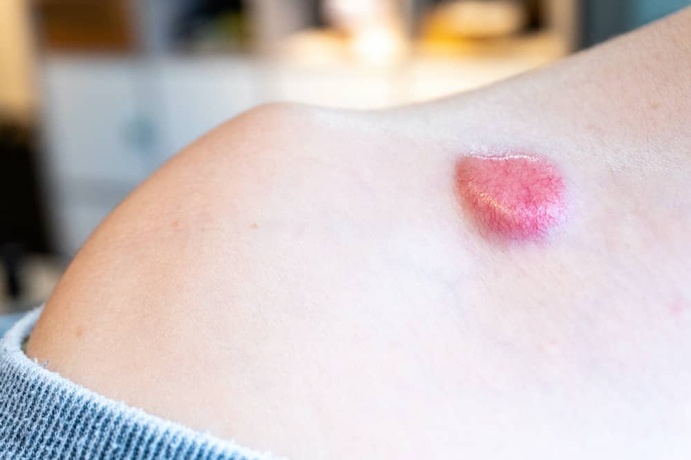 Person's shoulder with skin cancer non-melanoma growth