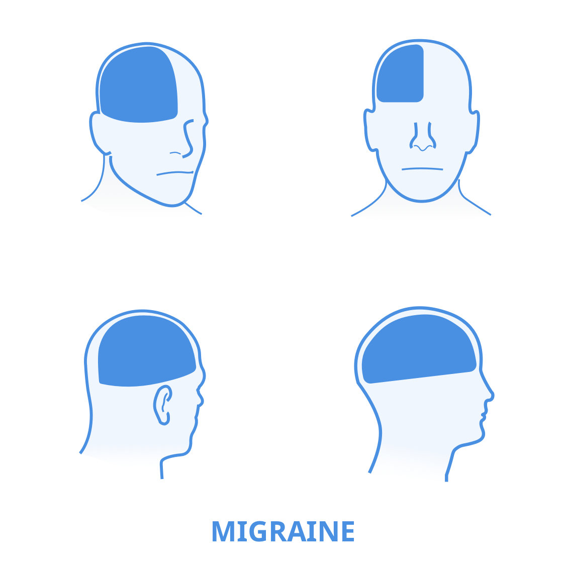5 Types Of Headache And Their Locations