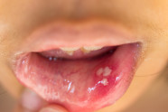 Mouth Ulcers And Cold Sores What s The Difference 