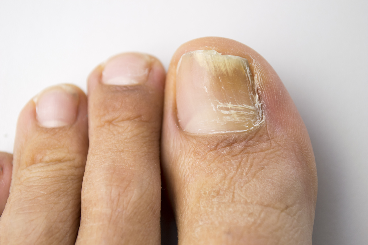 Fungal nail infection on toenail