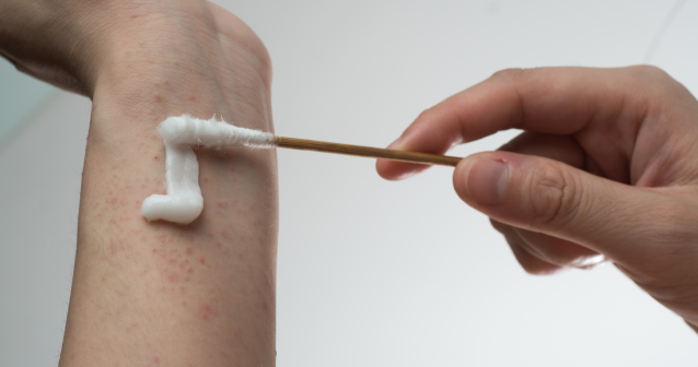 Steroid creams can be applied to skin to treat eczema