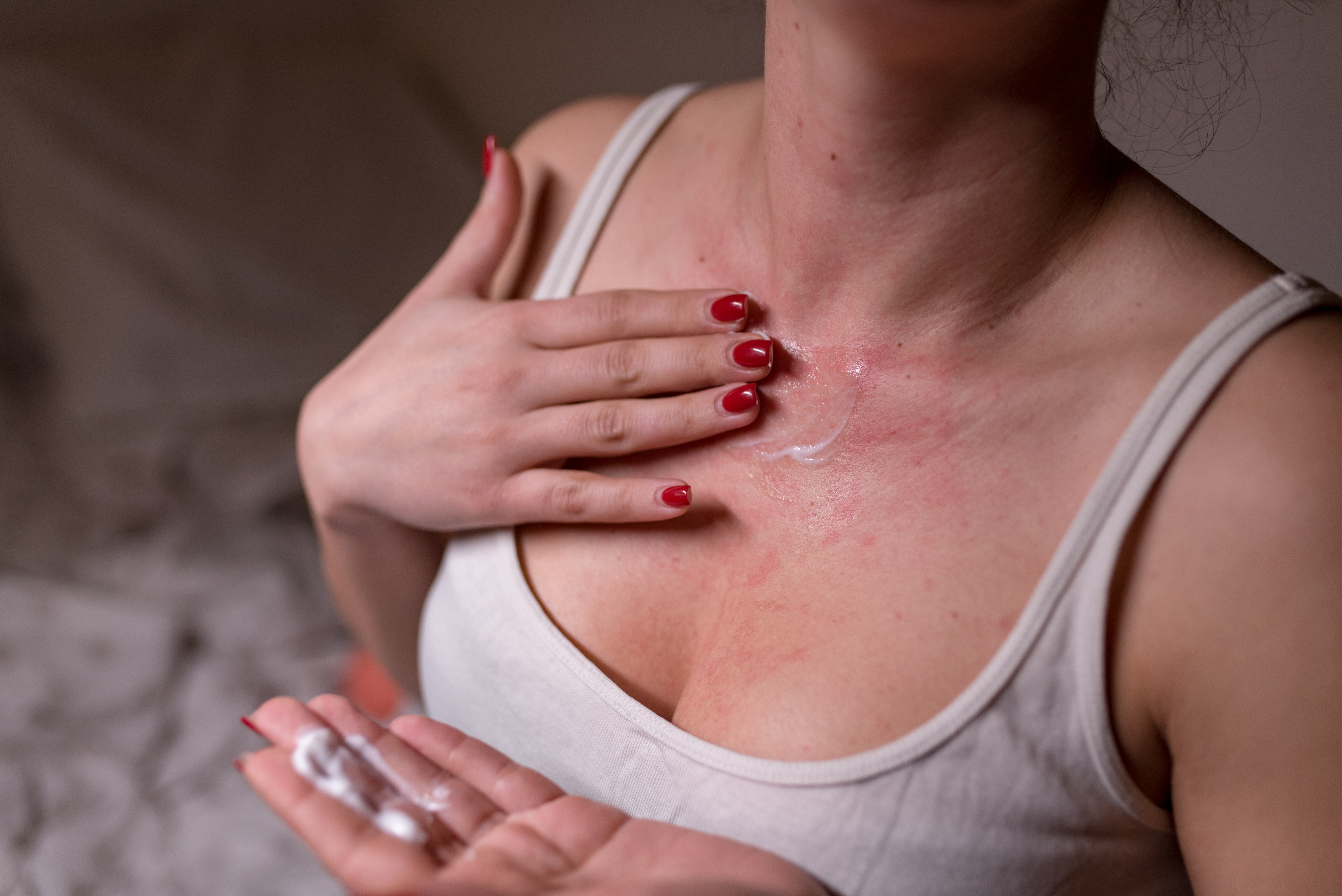 Heat rash, prickly heat, dermatitis and eczema can cause summer rashes.  Discover how to calm these irritations away.