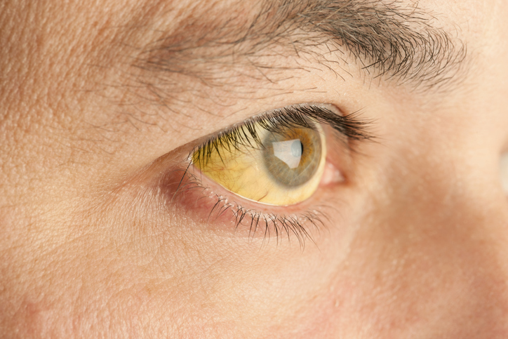 Close-up of man with yellow or jandice in the eyes