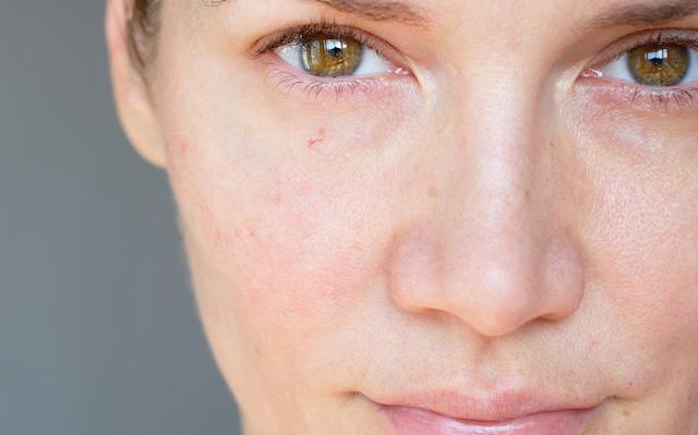 Mujer de piel lozana con manchas en su rostro 