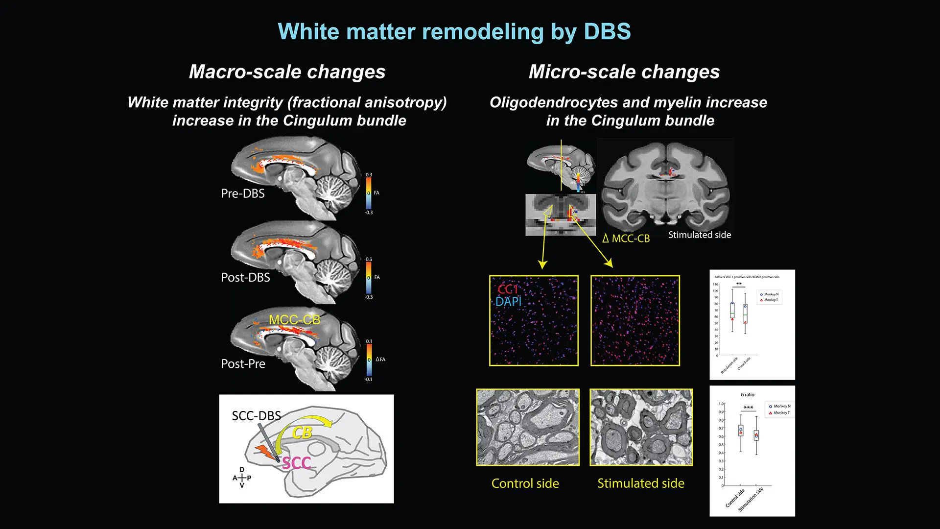 Figure 2. The effect of subcallosal ACC deep brain stimulation on white matter in the brain. Credit: Satoka Fujimoto, PhD 