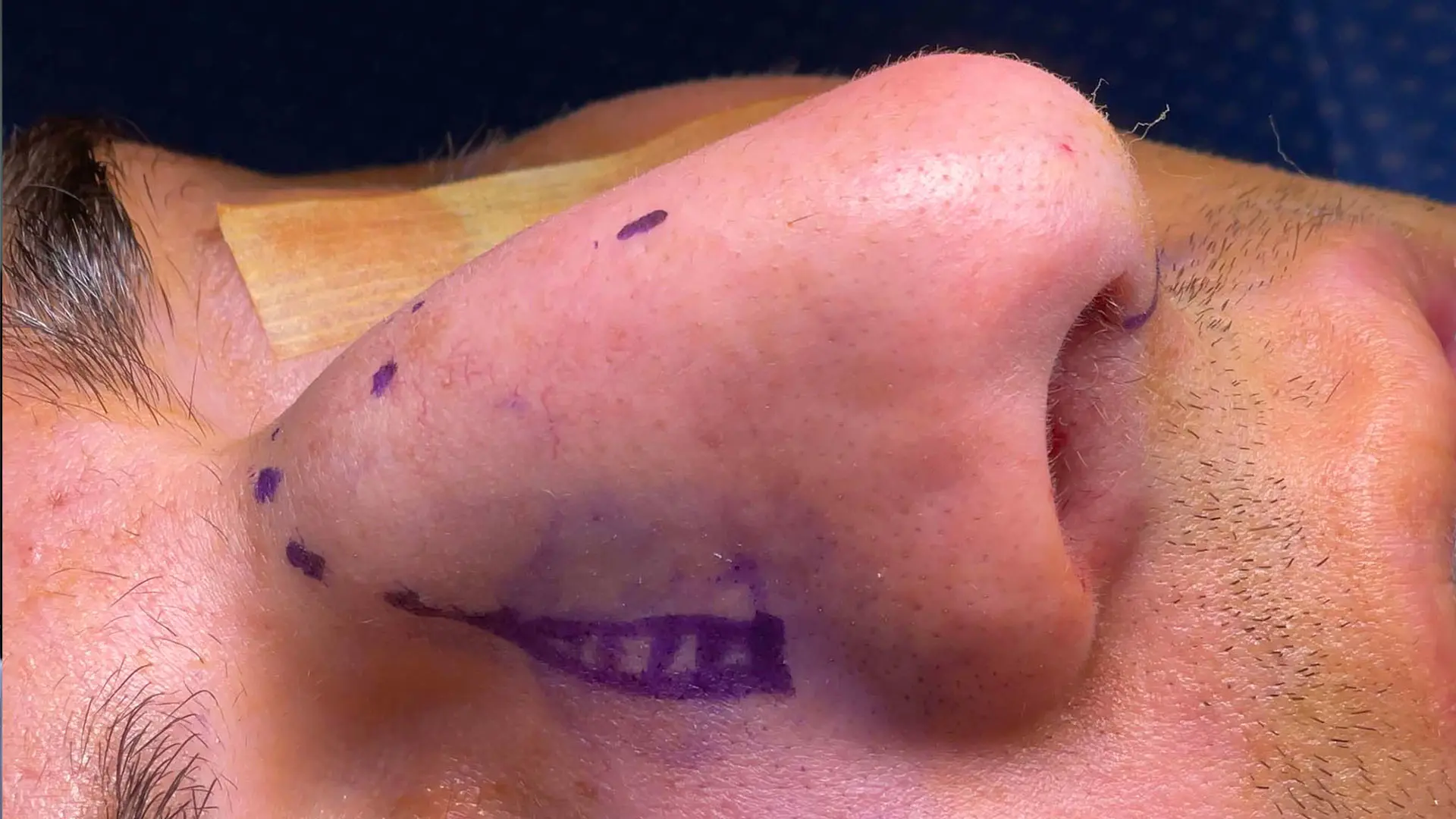 A nose marked for dorsal preservation rhinoplasty.