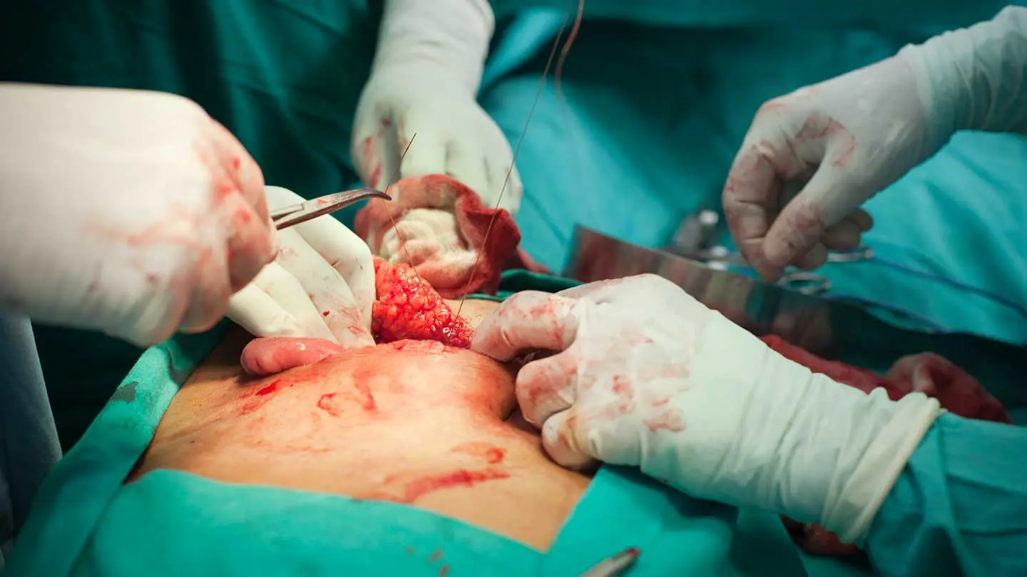 HCV-Positive Kidney Transplants Expand Available Pool of Organs