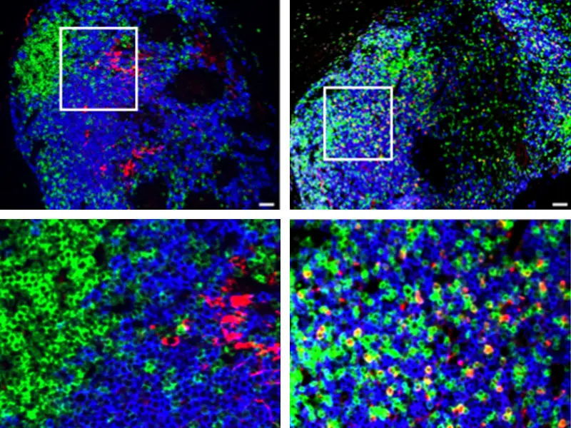 Representative images from a healthy control (left) and a patient with ulcerative colitis (right), highlighting the presence of CXCL13-producing T cells in ulcerative colitis. T cells are indicated by CD3 (green), B cells by CD20 (blue), CXCL13 is shown in red, and DAPI (for cell nuclei) is in grey.