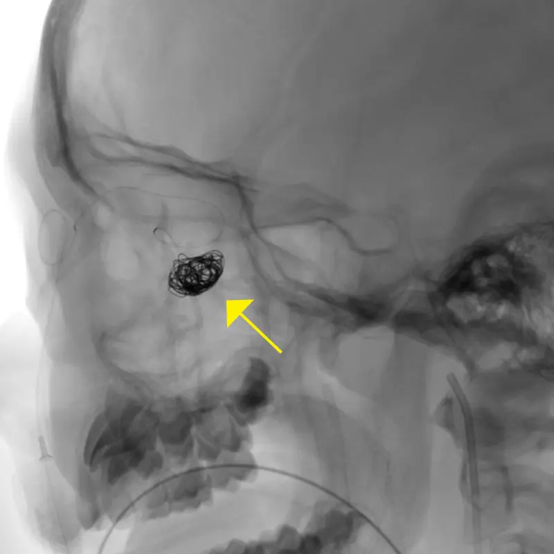 Platinum coil being inserted into the AV fistula (yellow arrow)