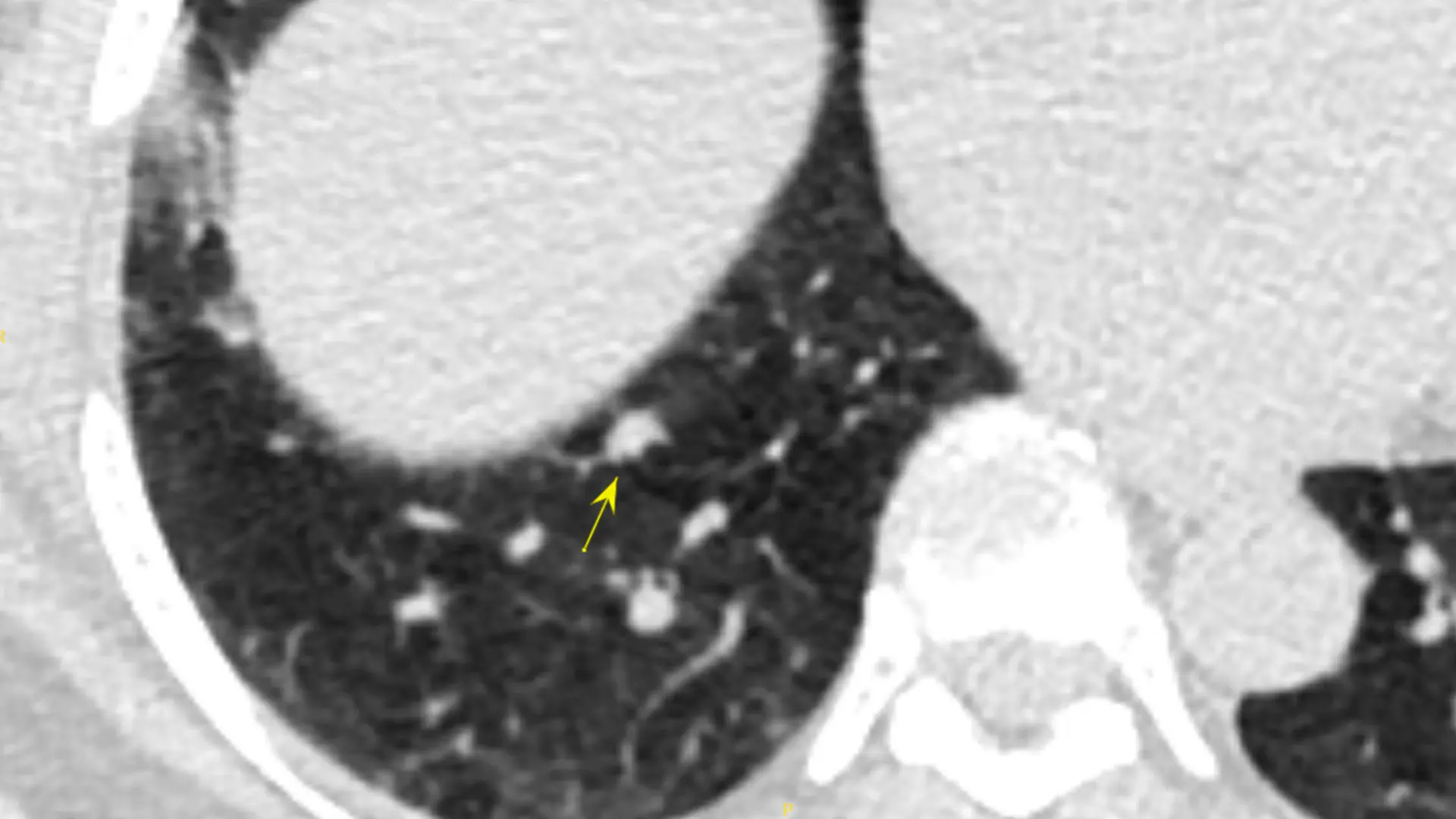 Solid nodule 8x6 mm: also needs follow-up in 6-12 months according to the guidelines.