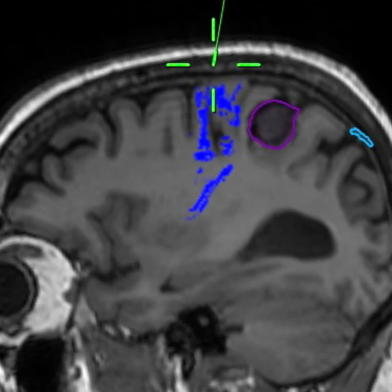 Top Center. Sagittal T1-weighted brain MRI with tractography sequences based on diffusion-weighted imaging techniques. The corticospinal tracts descending from primary motor cortex are highlighted in blue, anterior to the tumor. 