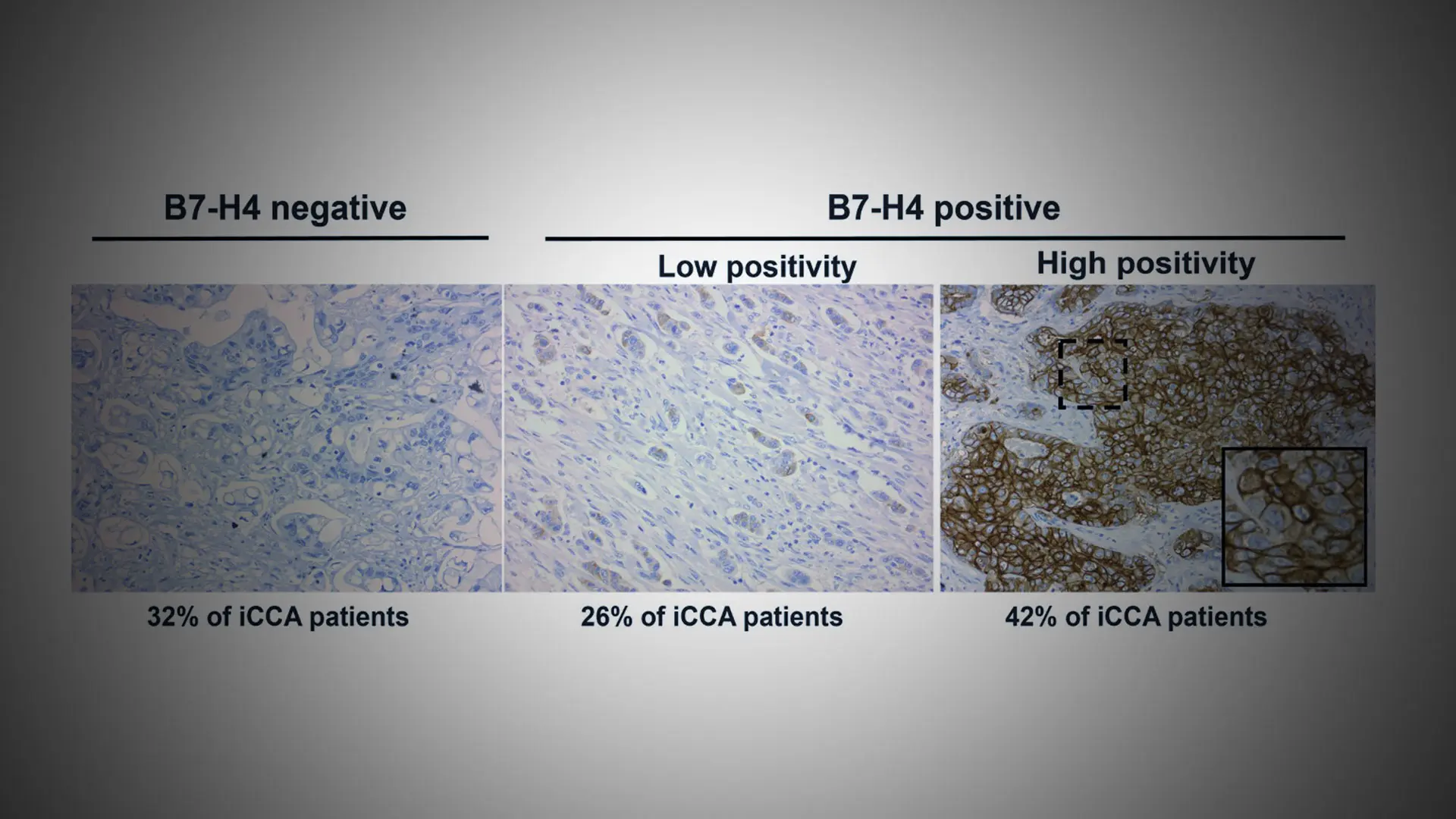 Protein Identified as Potential New Target for Treating Cholangiocarcinoma