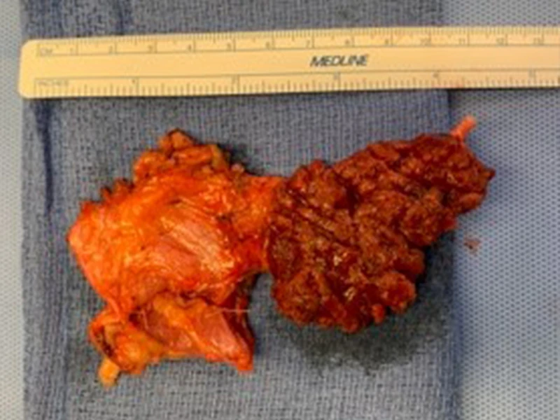 This laryngeal chondrosarcoma was removed from a patient’s cricoid cartilage, which was destroying his airway. Dr. Courey cut out the cancer and then reconstructed the cricoid cartilage using a rib graft with a microvascular free-flap. 