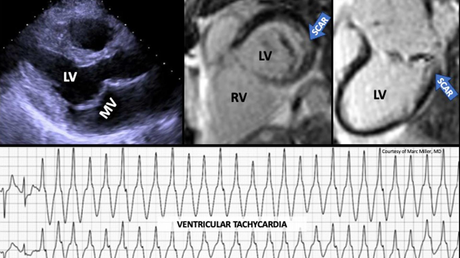 Images were obtained from a man in his mid-50s with asymptomatic degenerative mitral valve prolapse (bi-leaflet) with mild-moderate mitral regurgitation, who had an episode of syncope without prodrome. A subsequent ambulatory ECG monitor was notable for frequent salvos of ventricular tachycardia. Cardiac MRI imaging demonstrated replacement fibrosis (scar) in the basal infero-lateral left ventricle. 