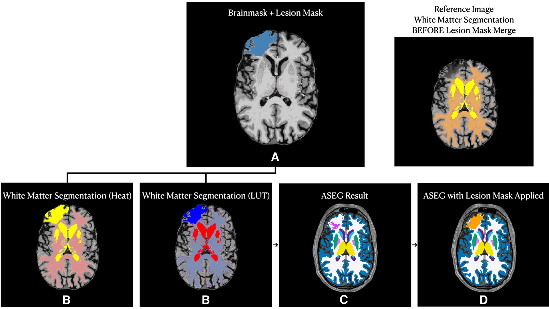 Cortical lesions can be a common feature of traumatic brain injury. However, as cortical lesions can lead to inaccurate surface renderings in automated segmentation pipelines, patients with large lesions could be excluded from studies, which can contribute to non-random missingness bias and limits the generalizability of findings. In this phenotype study, the team applied a lesion-correction methodology, which screened all T1-weighted images for the presence of cortical lesions. Lesions that disrupted the cerebral cortex were traced by a study investigator, and multiple investigators confirmed that cortical lesion tracings covered the entire lesioned area and that the lesion boundary did not extend into ventricles. Investigators then merged cortical lesions with the initial white matter segmentation, generating a "lesion-corrected" white matter mask. 