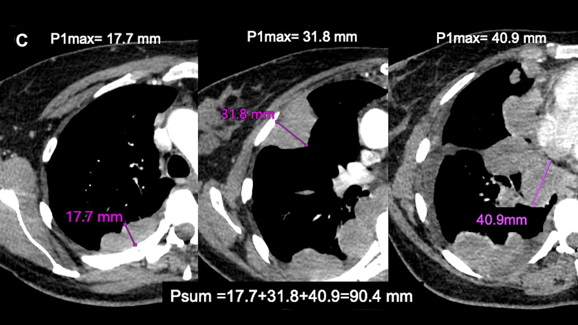 3. Axial images with maximal pleural thickness measurement at each of the three levels; P1max=17.7 mm; P2max=31.8 mm and P3max=40.9 mm, and Psum=17.7 + 31.8 + 40.9=90.4 mm