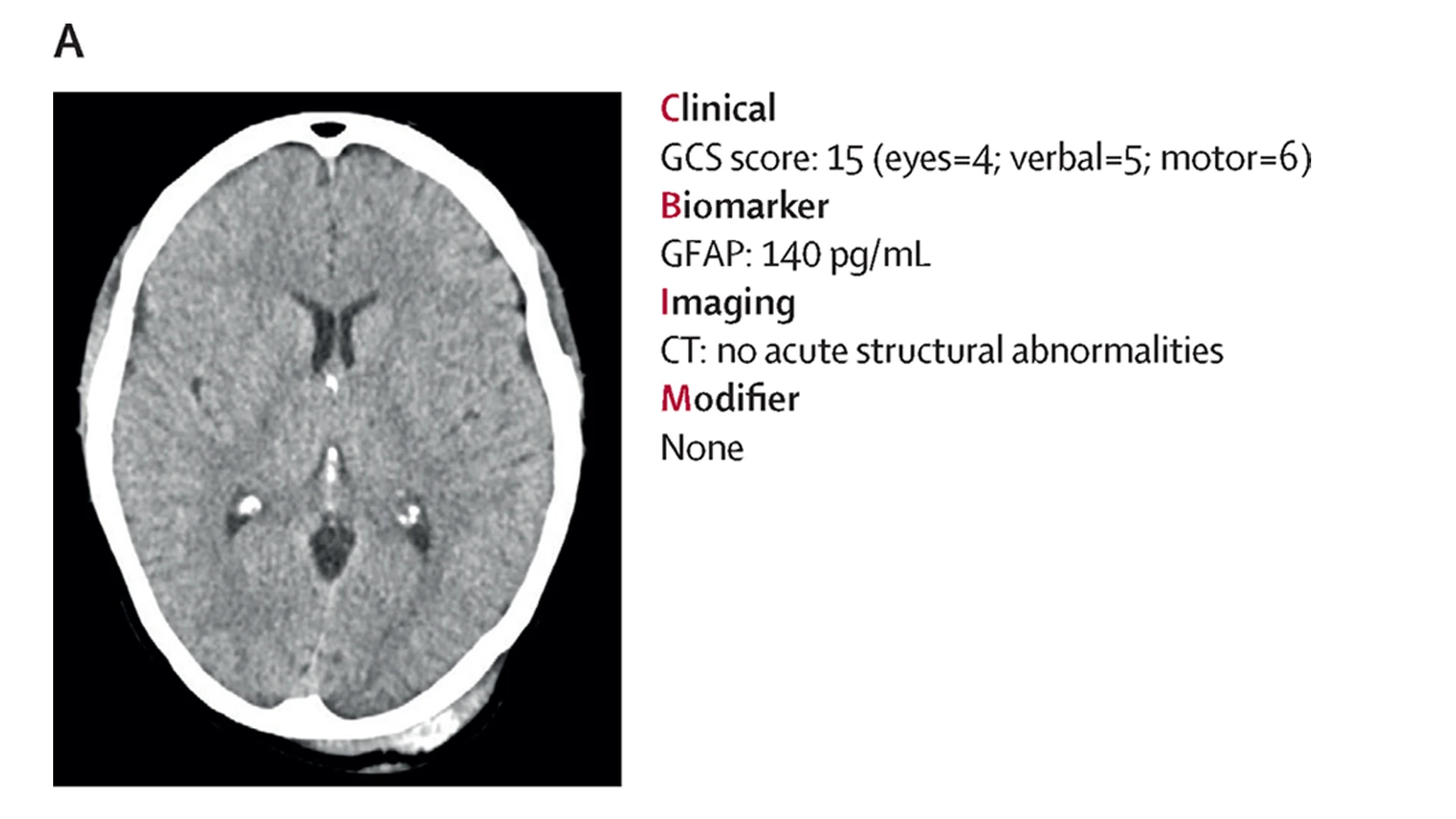 Here are case examples of how the CBI-M framework enhances care for TBI patients. The CT scan shows Patient A, a 28 year old male, injured by a bicycle crash. The patient was classified as having mild TBI based on GCS score alone. The patient presented brief post-traumatic amnesia, and the CT scan showed no acute abnormalities. Using the current terminology of mild TBI, the patient would likely be discharged without arrangements for follow-up care. However, with the CBI-M framework, there was biomarker information, with concentration being more than the 51–71 pg/mL reference range in healthy adults and in the presence of multiple acute symptoms, the patient would be referred for follow-up and symptom-targeted treatment.