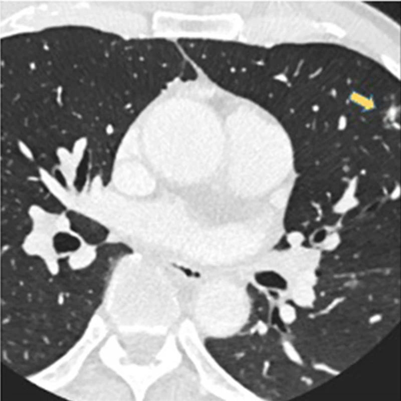 On a coronary angiogram, a nodule is visible in the upper right-hand corner, corresponding to the left upper lobe.