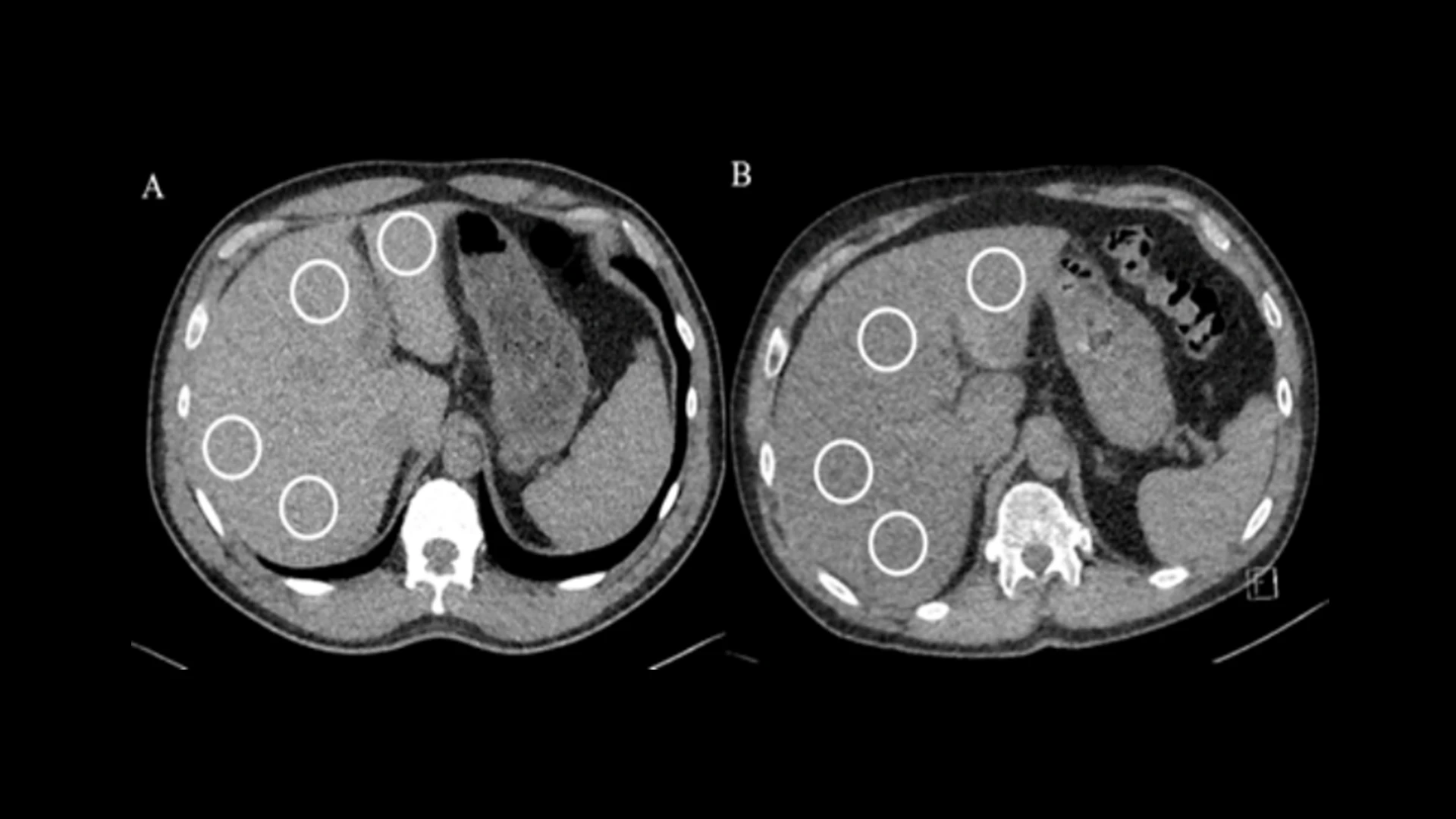 Liver density measurements on non-contrast chest CT in WTC participants. Averaged normal liver attenuation (59.5 HU) was noted in a 56-year-old male (A) and averaged lower liver attenuation (25 HU) was noted in a 57-year-old male (B), consistent with hepatic steatosis. Region of interest (white circles) measurements were placed in the right posterior, right anterior, left medial, and left lateral segments of the liver to determine liver attenuation, avoiding lesions and vessels.