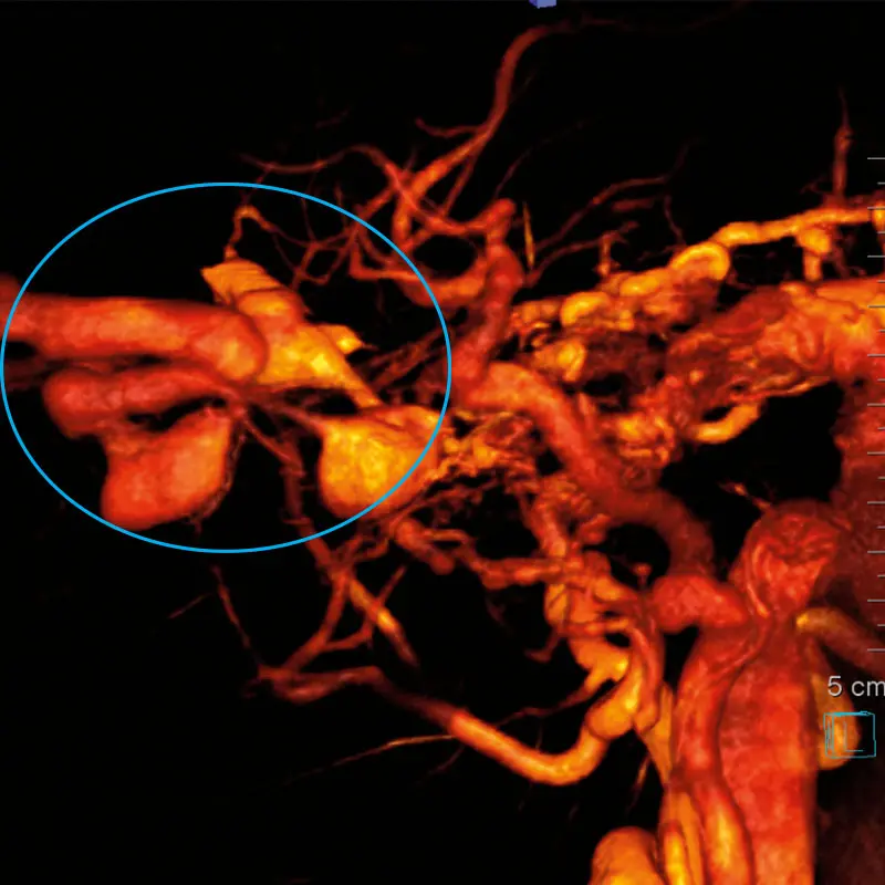 3D reconstruction of an angiogram of the right common carotid artery showing large orbital AVM (circled)