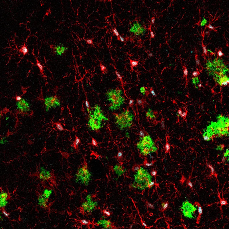 Figure 2. Immunostaining of the brain of a mouse model of AD xenotransplanted with human microglia. Green: amyloid plaques; red: microglial cells; cyan: marker of human microglia. Credit: Carmen Romero-Molina, PhD