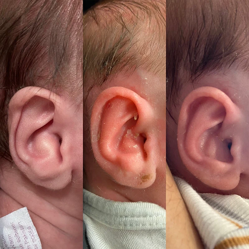 Newborns with abnormal ear anatomy can be treated with noninvasive ear molding, a procedure that reshapes the ear over the course of a few weeks.