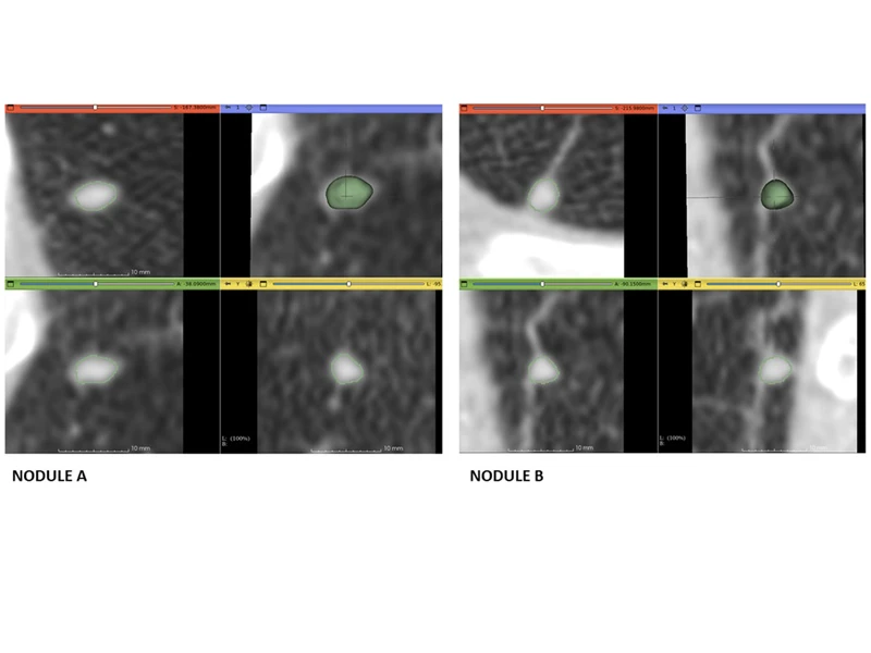 The smaller the volume of a lung nodule, the more challenging it is to measure. Additionally, measuring the solid and nonsolid components of a part-solid lung nodule is important for proper lung cancer screening management. AIRS demonstrated fully automated deep learning AI lung nodule volume segmentation of two solid lung nodules (left and right quadrant views) from a low-dose CT lung scan on a single screening participant. The image shows the axial (red), coronal (green), sagittal (yellow), and 3D (blue) views with the segmentation outline/surface of 2 different nodules displayed in green.